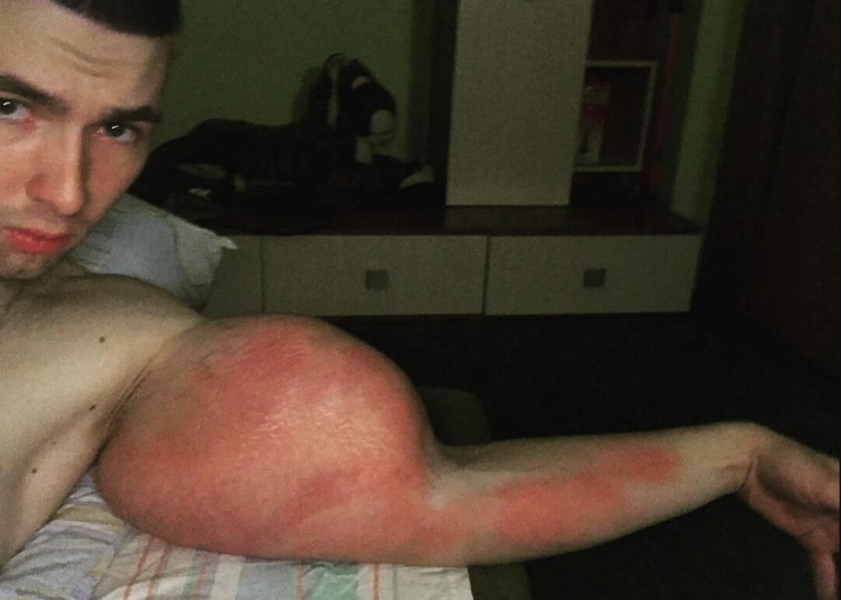 Como Identificar e Tratar Complicações de Injeção de Óleo nos Músculos