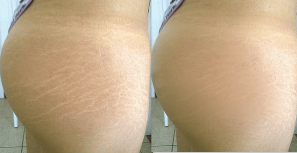 melhores cremes para estrias vermelhas