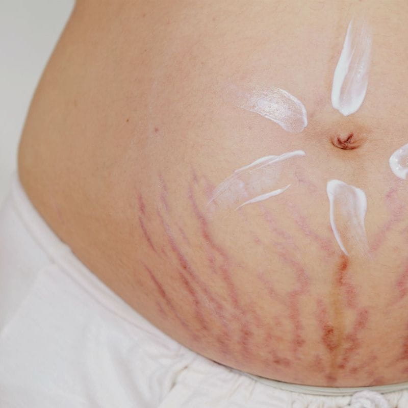 erros comuns ao tratar estrias brancas