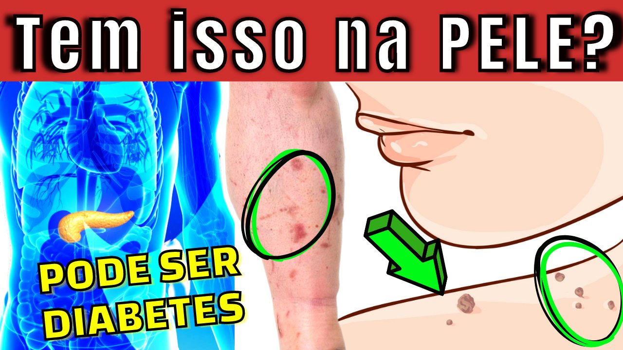 diabetes sintomas iniciais