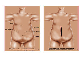 qual o tamanho de um estômago de um obeso