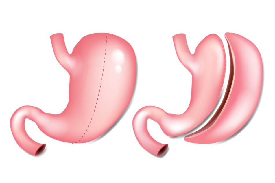 Bypass Gástrico vs. Sleeve: Diferenças na Redução do Estômago