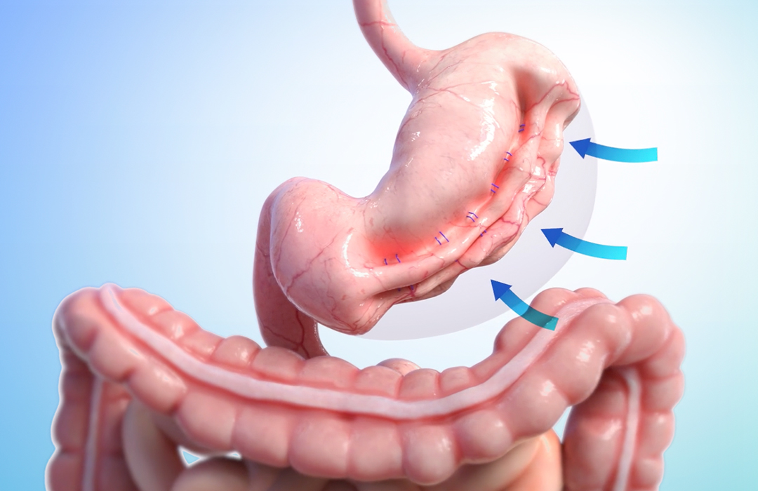 Volume do Estômago Vazio: O Que Acontece Quando Você Sente Fome