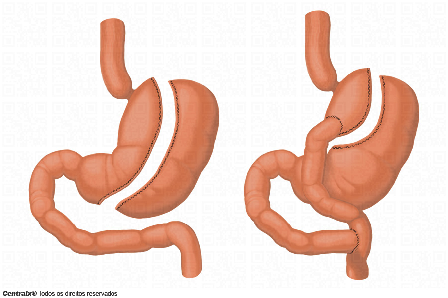 Volume do Estômago Vazio: O Que Acontece Quando Você Sente Fome