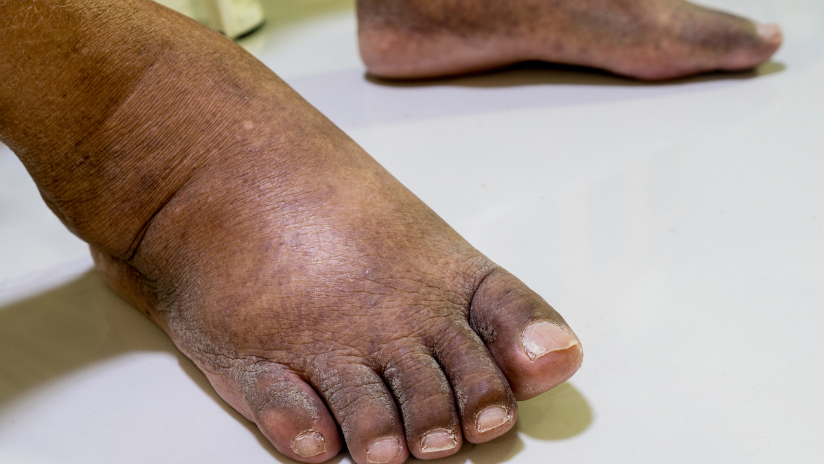 7 dicas essenciais para cuidar do pe diabetico e evitar complicacoes