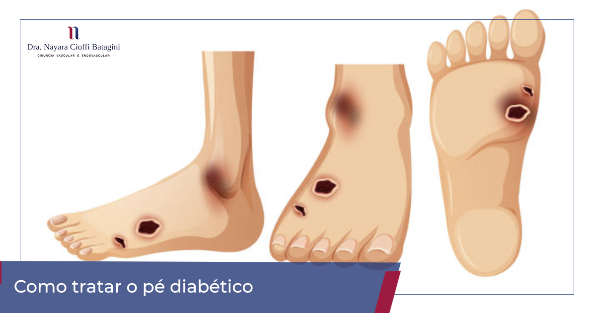 7 passos essenciais para cuidar do pé diabético e evitar queimaduras