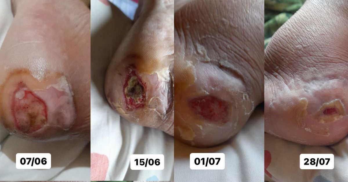 os maiores erros no tratamento de queimaduras em pés diabéticos