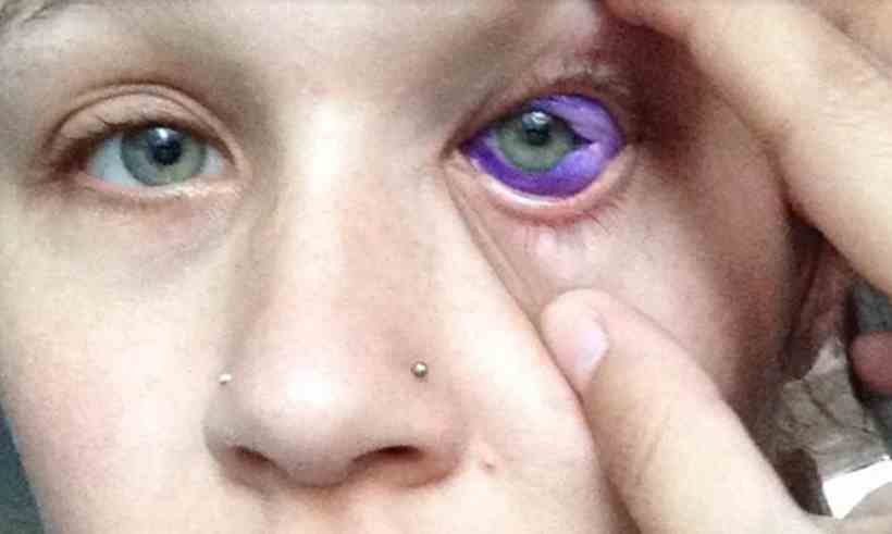 Antes de Fazer: Entenda os Riscos Irreversíveis da Tatuagem Esclerótica