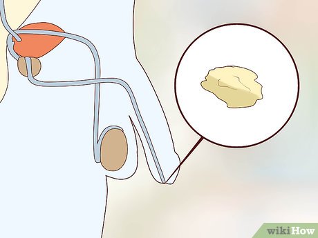 tricomoniase em homem