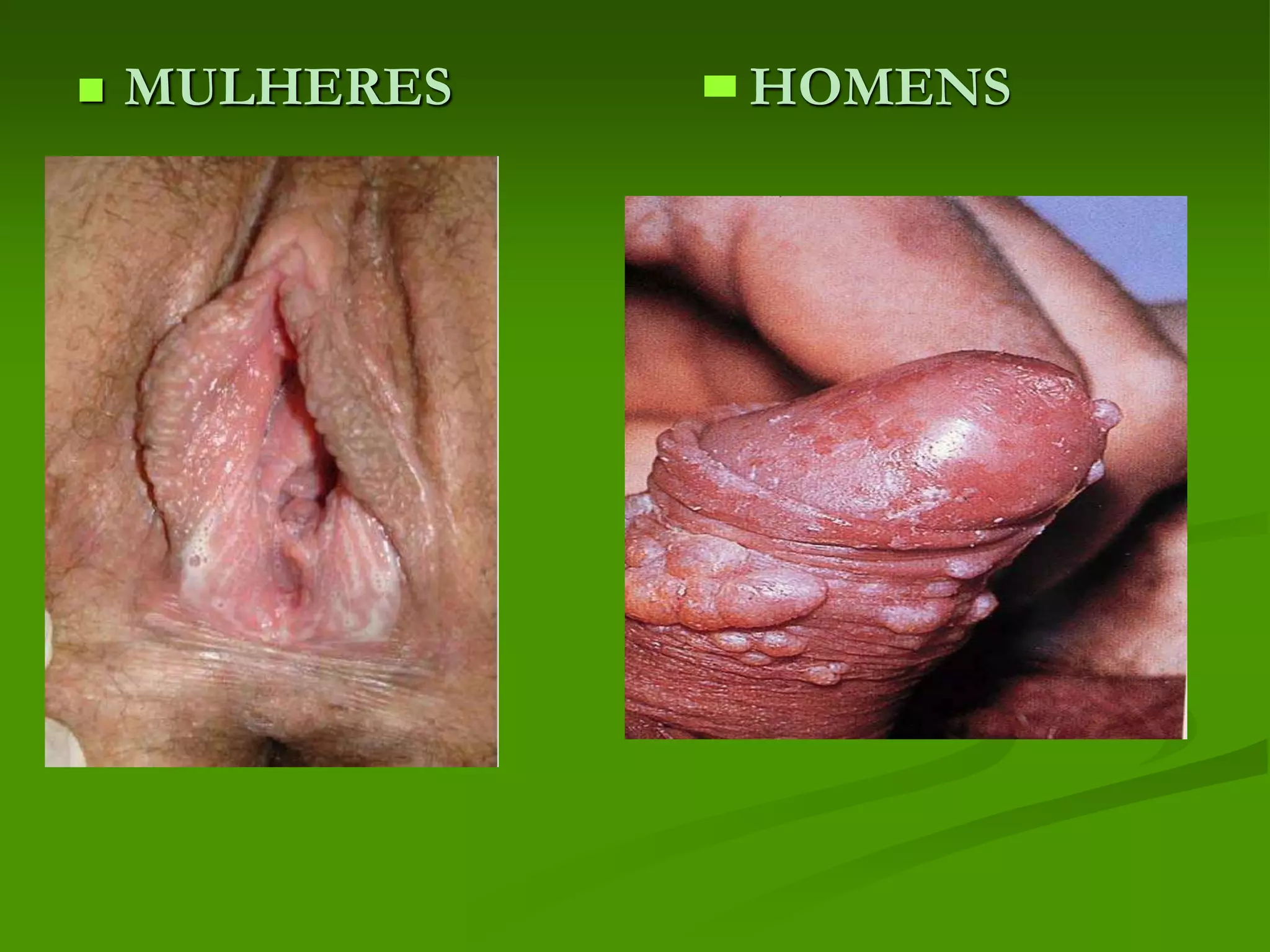 Tricomoníase Assintomática em Homens: O Guia Completo