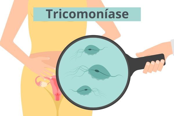 Prevenção da Tricomoníase: A Importância do Preservativo e Tratamento do Parceiro
