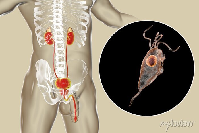 Prevenção da Tricomoníase: A Importância do Preservativo e Tratamento do Parceiro