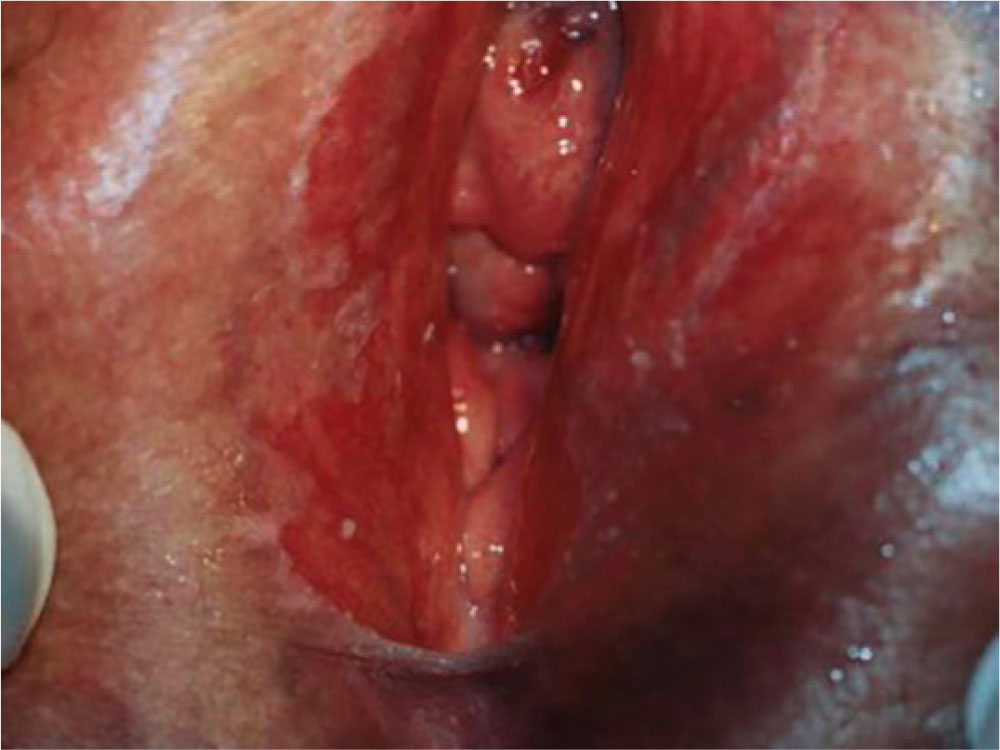 Tricomoníase Assintomática em Homens: O Guia Completo